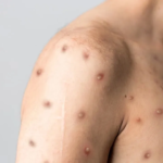 Irecê registra caso suspeito de Mpox e paciente está em isolamento